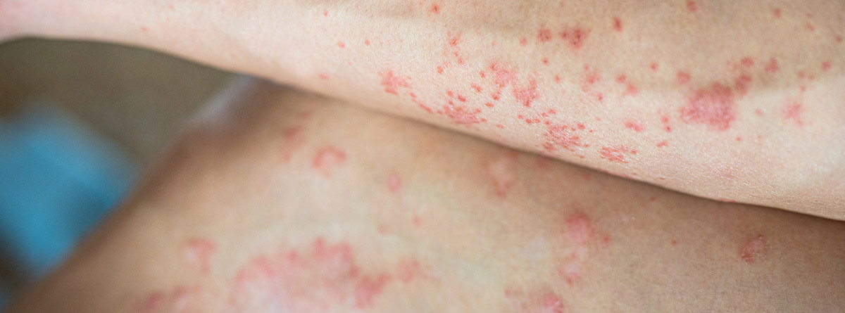 El Taulí tracta 650 pacients d'hidradenitis supurativa en la seva ...