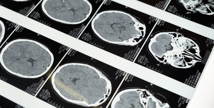 Arcadi Navarro, director Fundació Pasqual Maragall: "No puc dir si la cura de l'Alzheimer arribarà d'aquí 5, 10 o 15 anys, però el que sí que puc dir és que la ciència no ens fallarà"