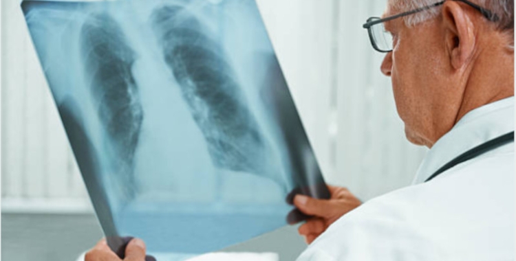 Una radiografia pulmonar/ Pexels