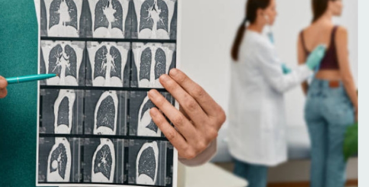 Unes radiografies d'un pacient amb fibrosi pulmonar/ Pexels