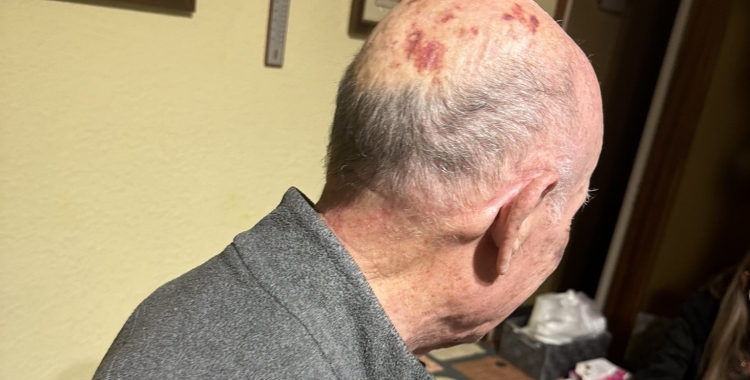 La família ha difós una imatge de l'avi amb les marques als ulls de la pallissa | @BertuSBD