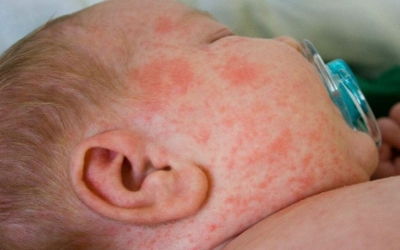 Imatge d'un nadó amb xarampió | Cedoc Perfil