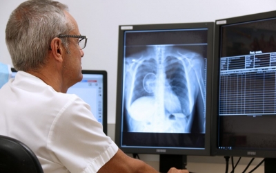 El Parc Taulí ultima un sistema automàtic de detecció de possibles càncers pulmonars | Cedida
