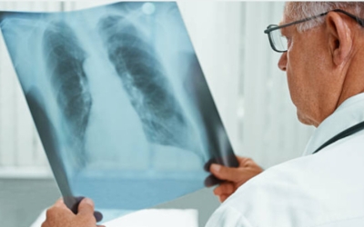 Una radiografia pulmonar/ Pexels