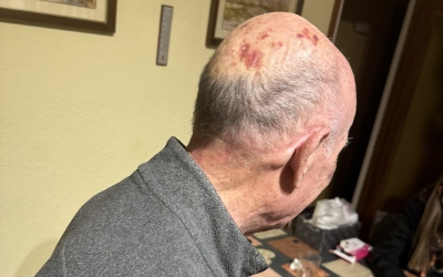 La família ha difós una imatge de l'avi amb les marques als ulls de la pallissa | @BertuSBD
