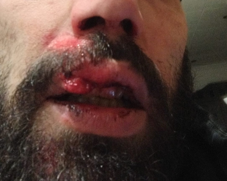 L'aficionat agredit va acabar amb cinc punts de sutura a la boca | Cedida